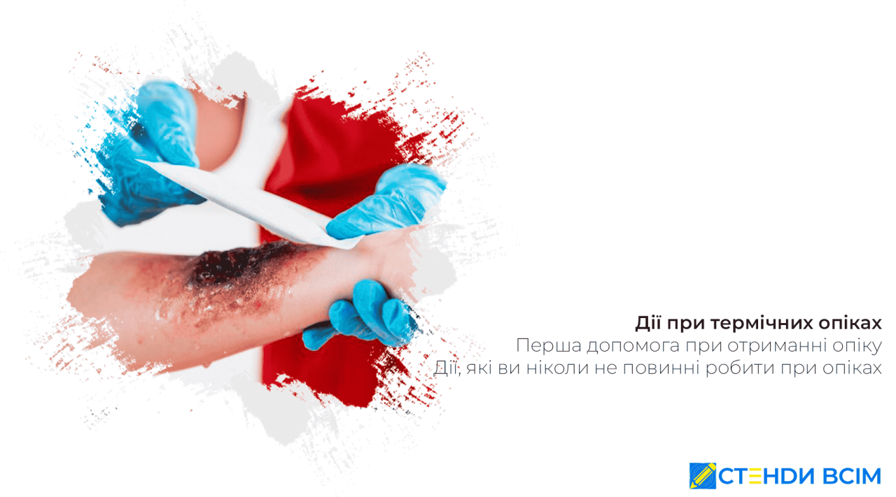 Дії при термічних опіках